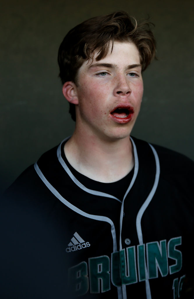 Rock Bridge infielder and pitcher Travis Bassford sits in the Rock Bridge dugout with a bloody lip
